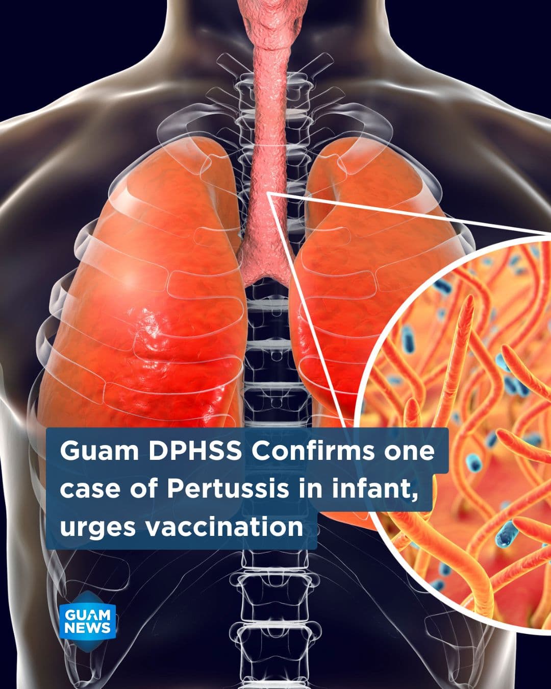 Public Health confirms whooping cough case in unvaccinated infant