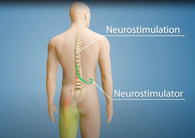 GRMC adds spinal cord stimulator for chronic pain treatment