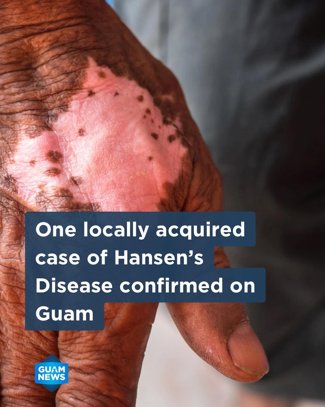 Public Health confirms locally acquired Hansen's disease case