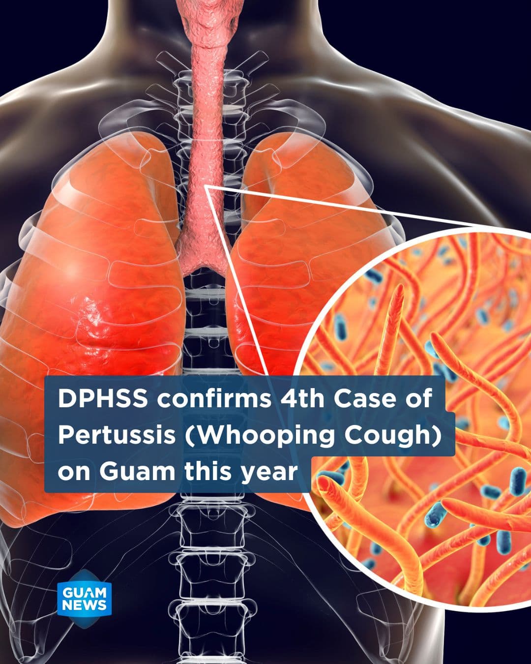Guam confirms fourth whooping cough case of the year